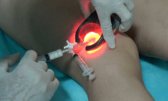 Die Sklerotherapie ist eine wirksame Methode zur Behandlung von Krampfadern in den Beinen.